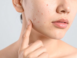 Managing Adult Acne Without Accelerating Ageing