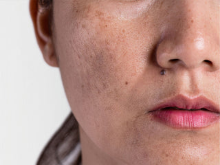 Why Pigmentation Becomes More Stubborn in Adult Skin